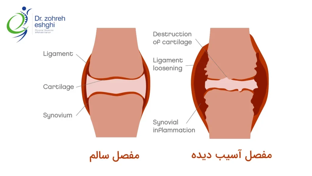 مفصل تخریب شده