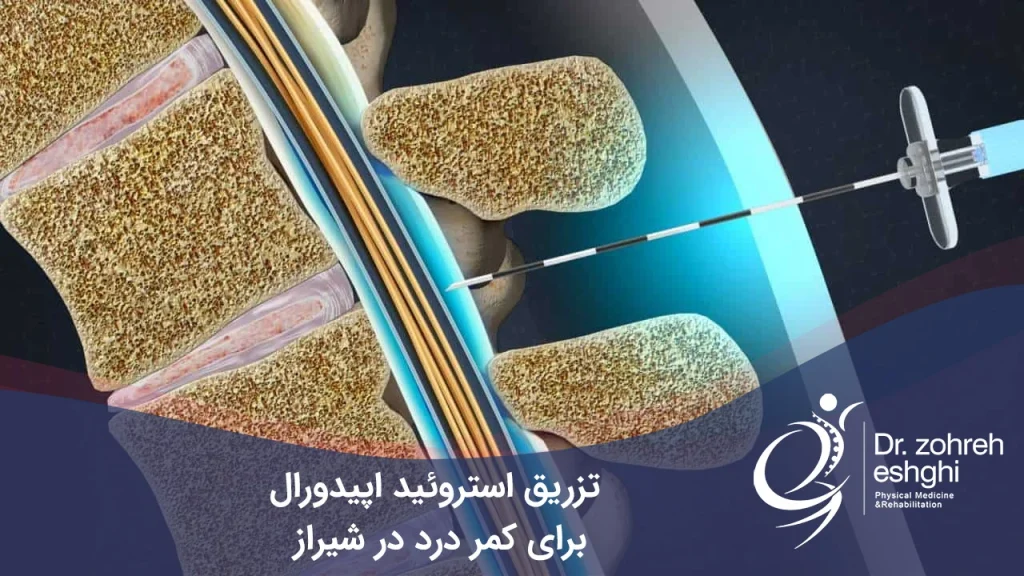تزریق استروئید اپیدورال برای کمر درد در شیراز