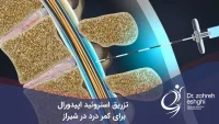 تزریق استروئید اپیدورال برای کمر درد در شیراز