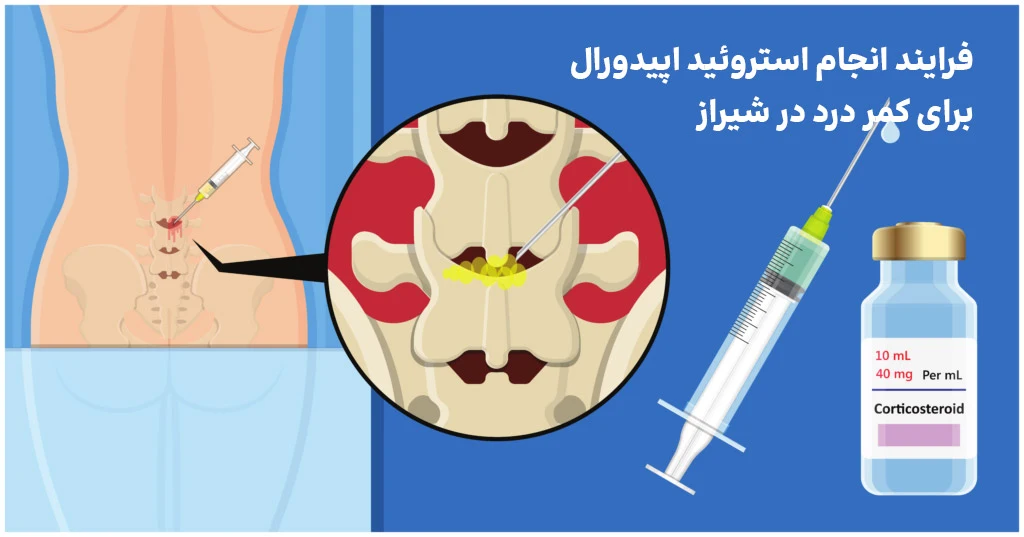 مراحل تزریق استروئید اپیدورال