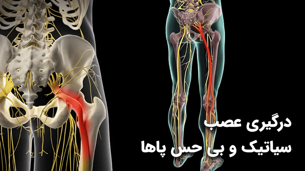 گرفتگی عصب سیاتیک و بی حسی مچ پا