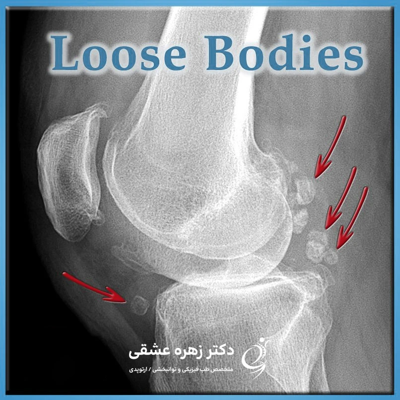 تصویر تشخیص لوزبادی یا قطعات شناور در زانو
